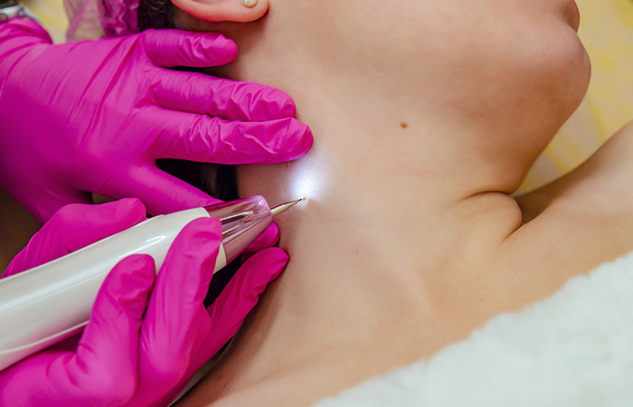 Esthetician removing skin tag on woman's neck