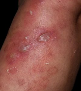 What Are Vesicular Skin Lesions The Complete Guide