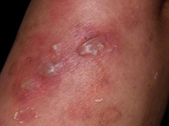 What Are Vesicular Skin Lesions The Complete Guide