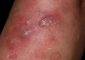 Vesicular Skin Lesions: Causes, Symptoms, Diagnosis, Treatment