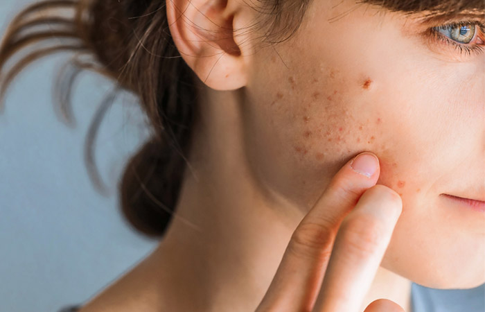 Young woman with blackheads on cheeks
