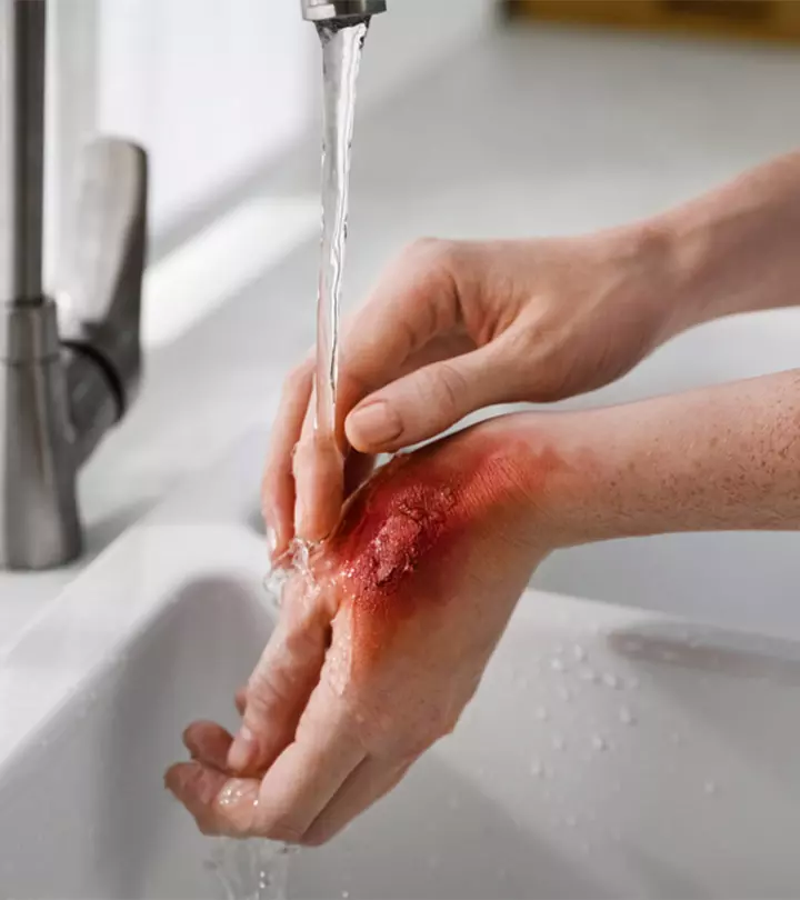 Person With A Chemical Burn On Her Hand