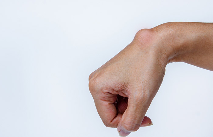 Woman's hand showing a cyst