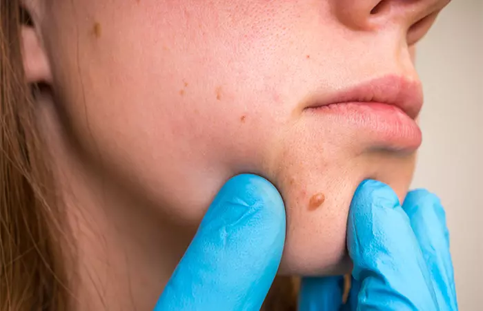 Close-up of a skin tag