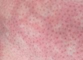 Mottled Skin : Causes, Symptoms, Diagnosis, And Treatment