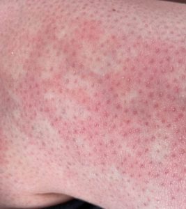 Mottled Skin : Causes, Symptoms, Diag...