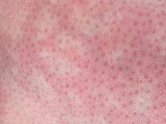 What Is Mottled Skin And Is It Dangerous For You
