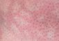 Mottled Skin : Causes, Symptoms, Diagnosis, And Treatment