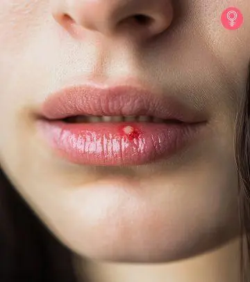 Woman Suffering From White Bumps On Lips