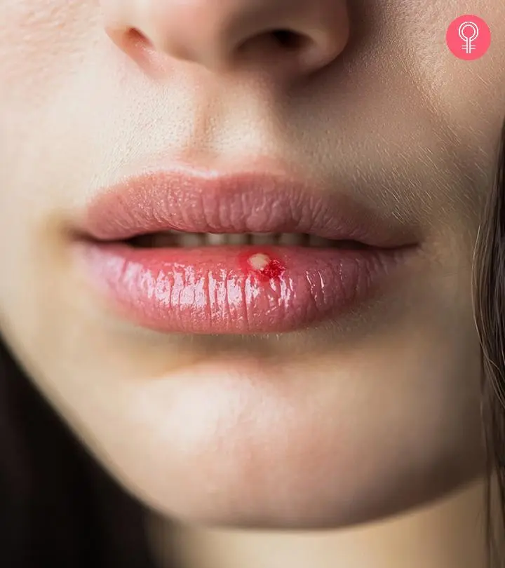 White Bumps On Lips Oral Mucocele Condition Treatments And Pictures