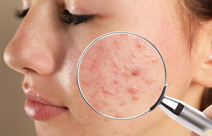 Glycolic and salicylic acid aid in acne treatment