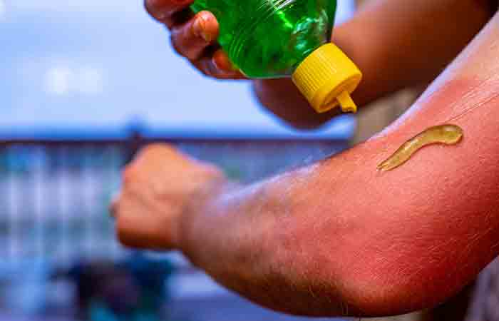 Person applying aloe vera gel to sunburnt skin