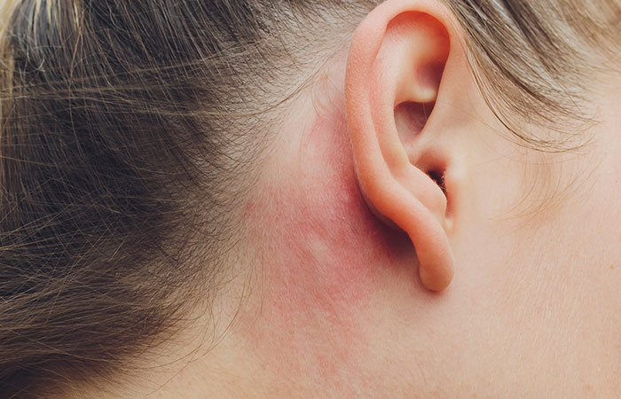 Woman with ear eczema