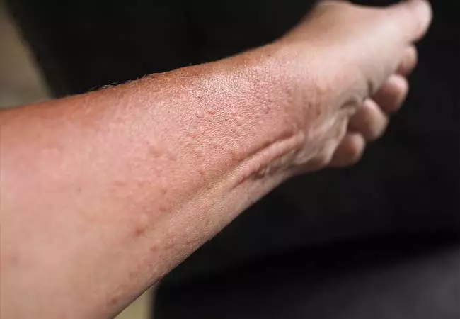 Contact dermatitis causes scaly skin