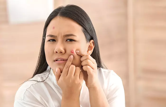 Helps-Reduce-Acne-Pimples