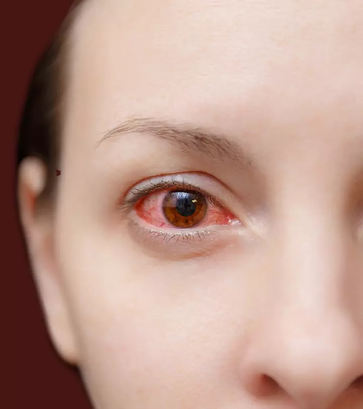 How To Get Rid Of Pink Eye A Guide To Curing Conjunctivitis