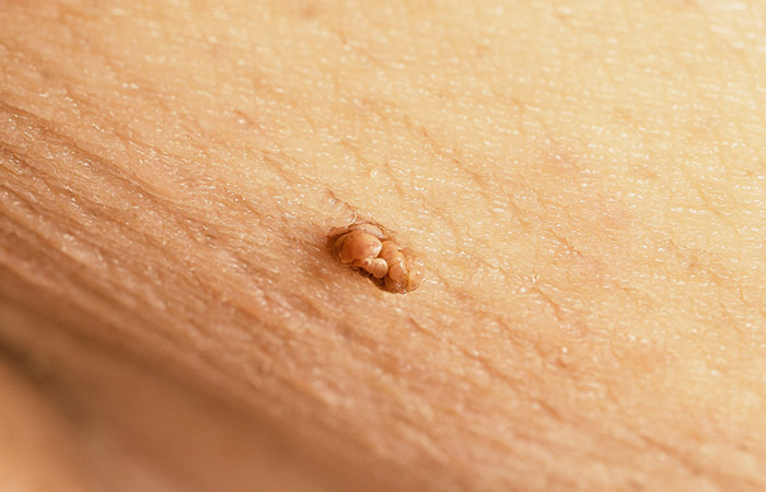Close up of a skin tag