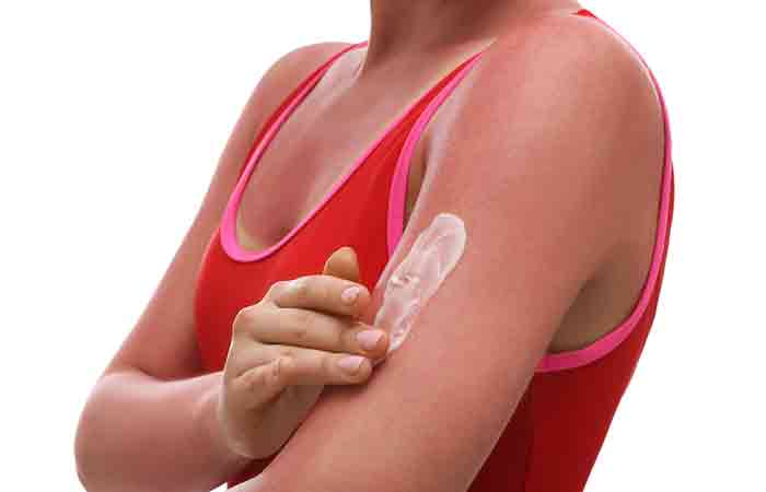 Woman with sun rash on her arms applies a soothing cream