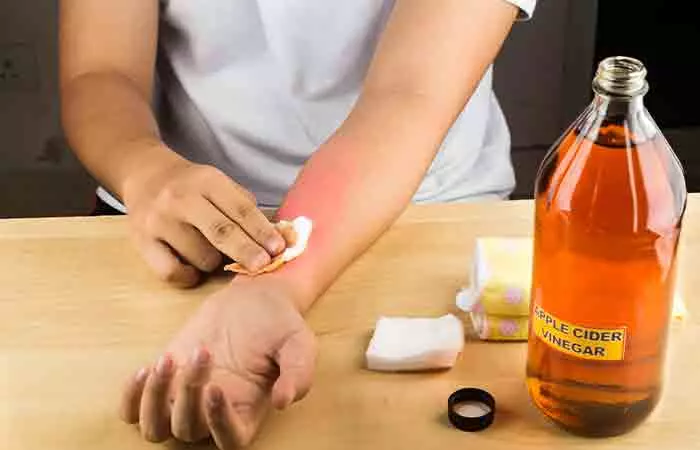 Person applying apple cider vinegar to sunburnt skin