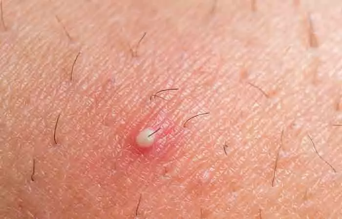 Ingrown hair may cause bumps on nipple