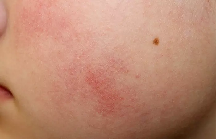 Salicylic acid aid in keratosis pilaris treatment