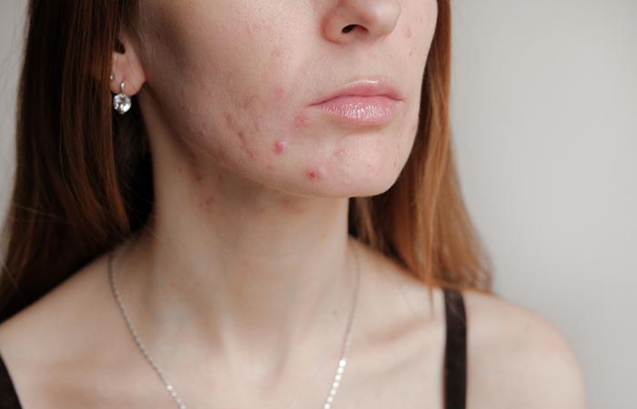 Woman with acne may benefit from star apple