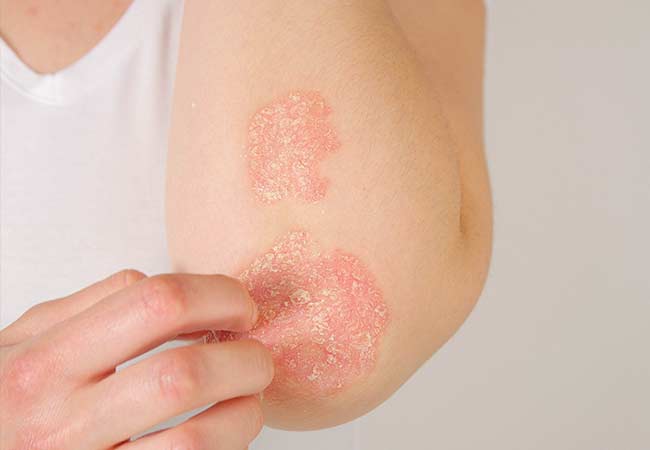 Psoriasis causes scaly skin