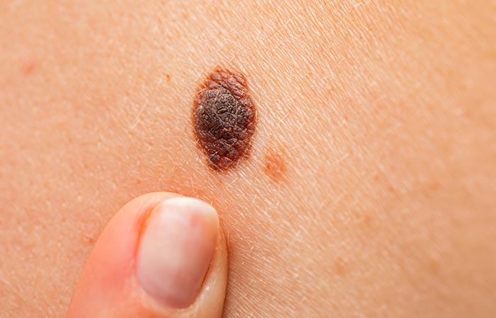 Moles are pigmented spots on the skin that are generally harmless but could be a sign of underlying conditions on rare occassions