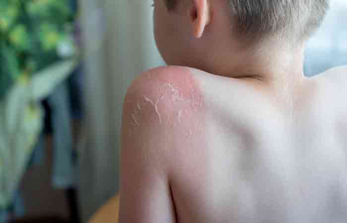 Blisters on a child's shoulder as a symptom of sun rash