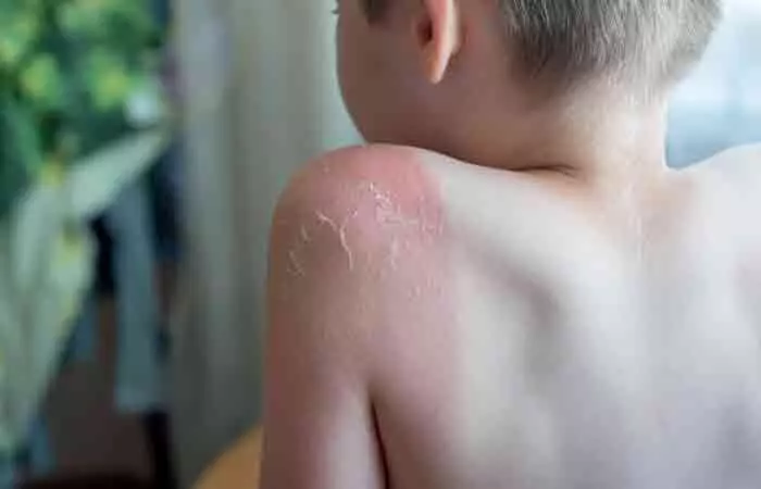 Blisters on a child's shoulder as a symptom of sun rash