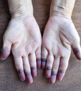 Cyanosis (Skin Discoloration): Causes...