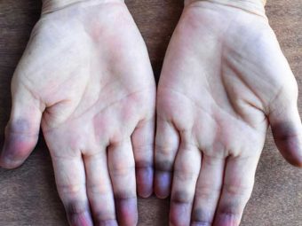 What-Is-Cyanosis-And-How-To-Treat-It