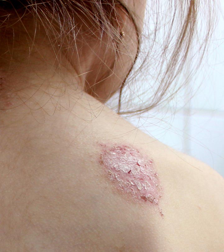 Discoid Eczema: Symptoms, Causes, How To Treat, & Prevention