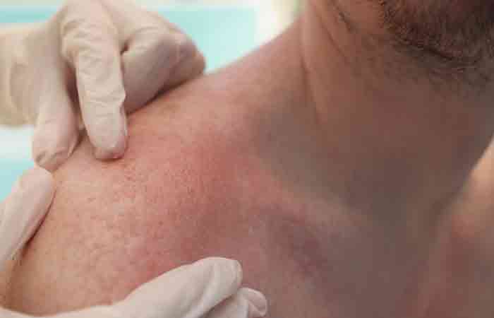 Doctor examining sun rash on a patient's shoulder
