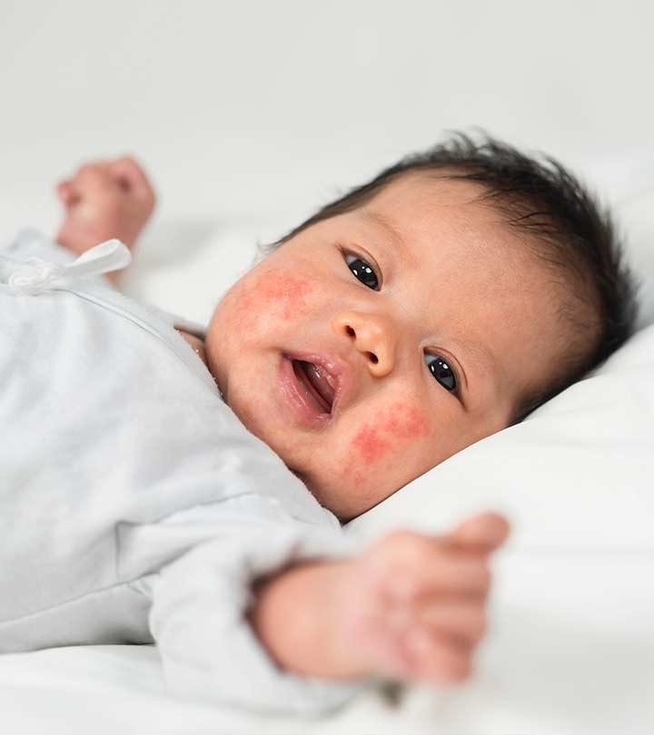 baby-rashes-causes-types-treatments-and-prevention-tips