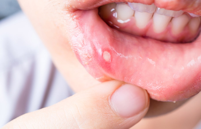 Canker sores may trigger gum pain
