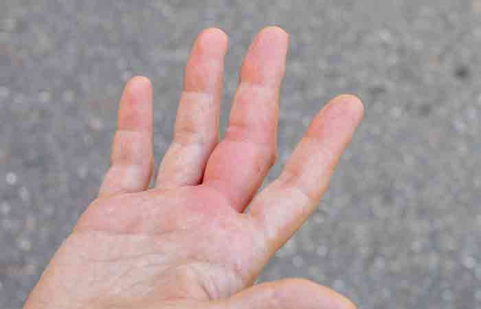 Swelling in fingers is a symptom of finger arthritis