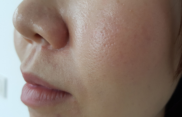 Excessive oiliness on the face is a cause of deep blackheads
