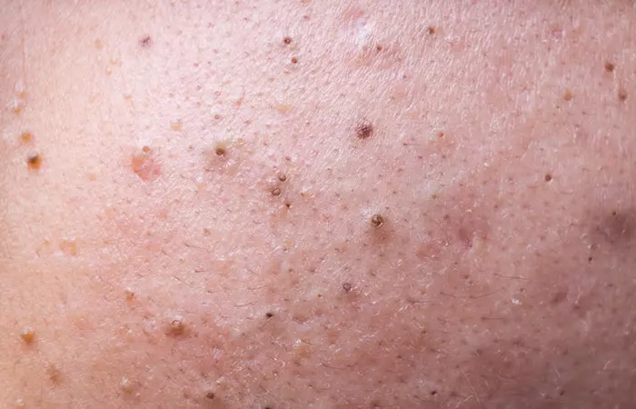 Deep blackheads on the face