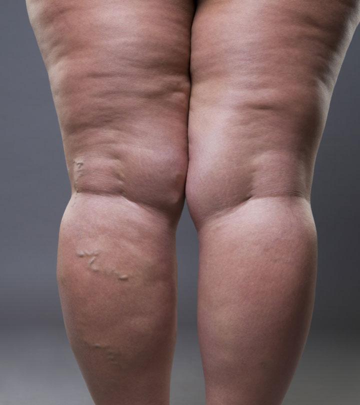 Lipedema and varicose veins