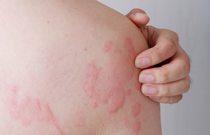Person with hives may benefit from low histamine diet