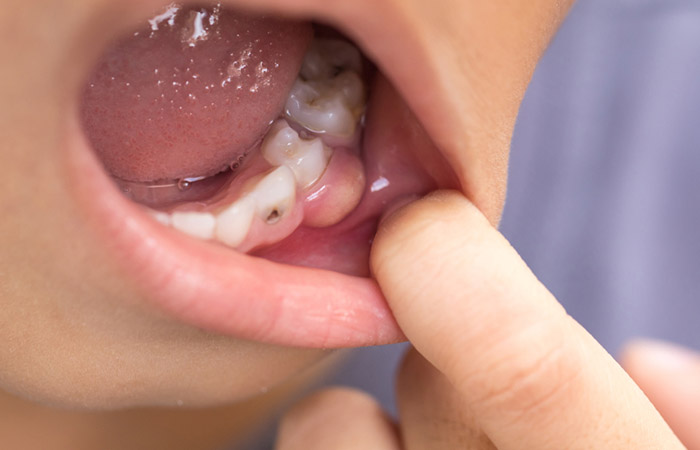 Tooth abscess may cause gum pain