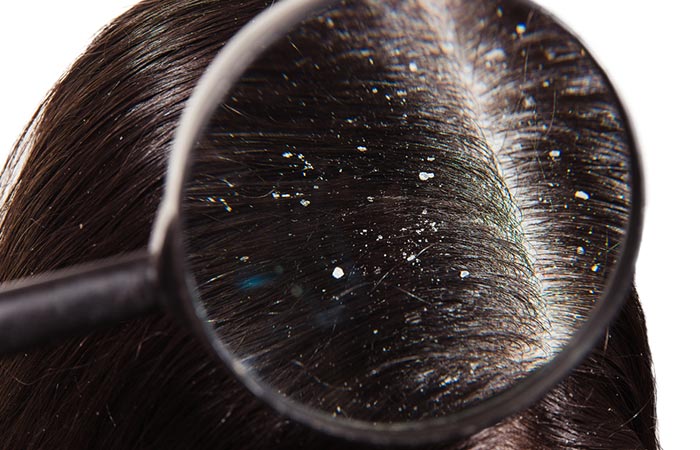 Close up on dandruff on the scalp to discover the cause of dandruff
