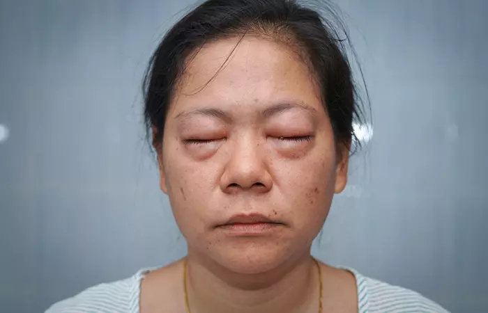 Woman with a swollen due to a drug allergy