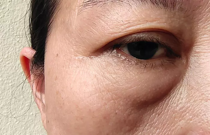 Woman with swelling in the undereye and cheekbone area