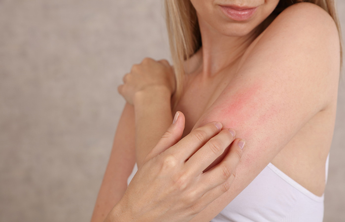 Woman having skin irritation due to allergic reaction 