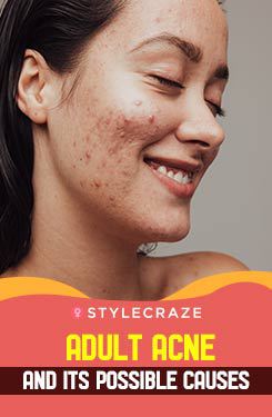 Adult Acne And Its Possible Causes
