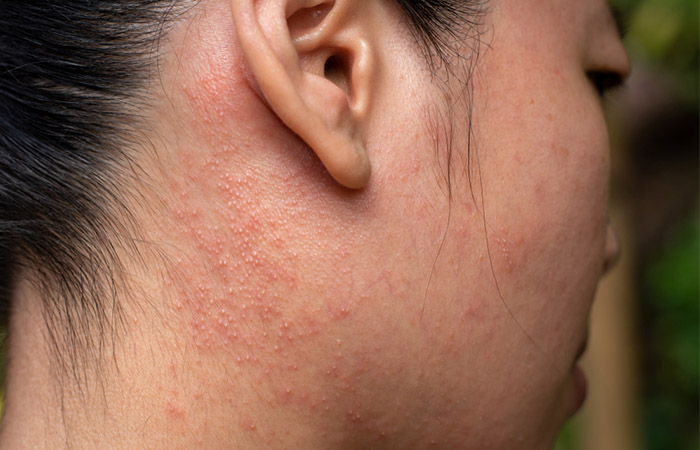 Contact dermatitis may cause dry and itchy skin