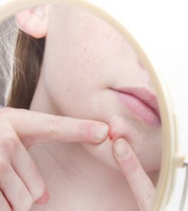 Dermatillomania All You Need To Know About Skin Picking Disorder