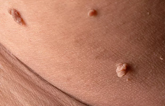 Skin tags